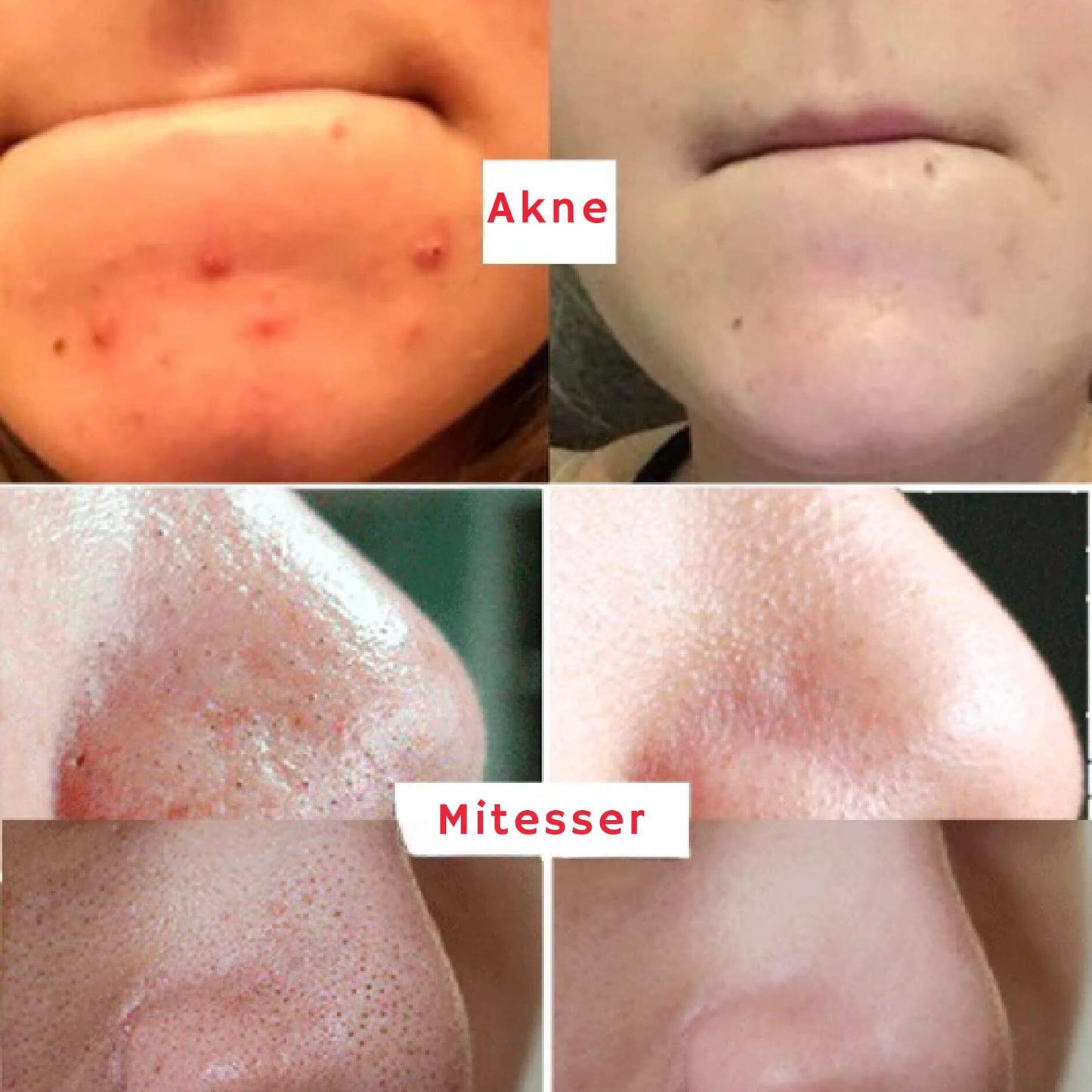 ClearSkin™ Reinigungs-Stick | Entferne Pickel und erhalte in 5 Tagen eine ebenmäßige Haut