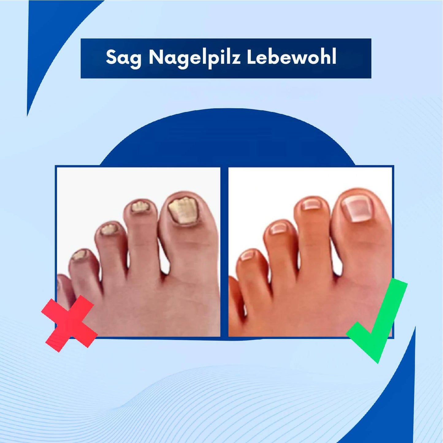 NailCure™ – Effektive Behandlung gegen Nagelpilz