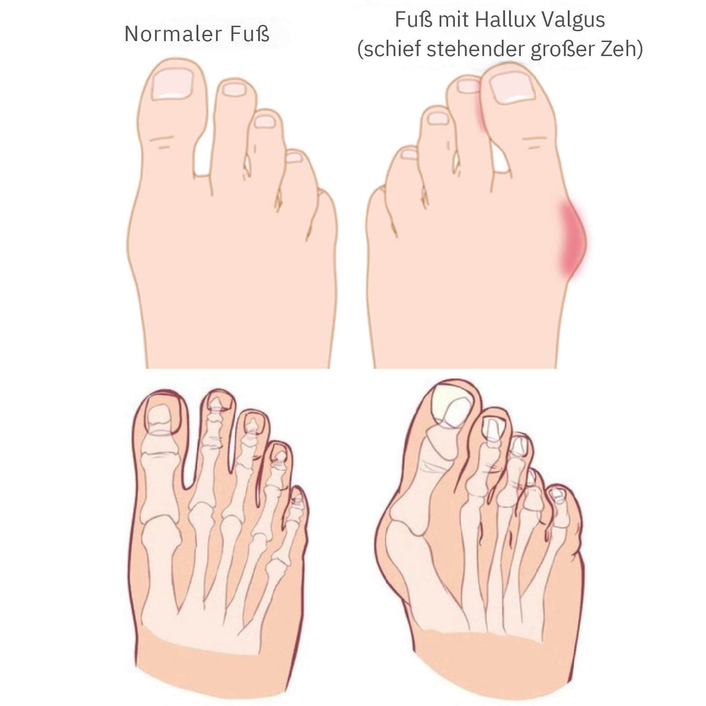 ToeAlign™ – Richtet deine Zehen sanft wieder aus