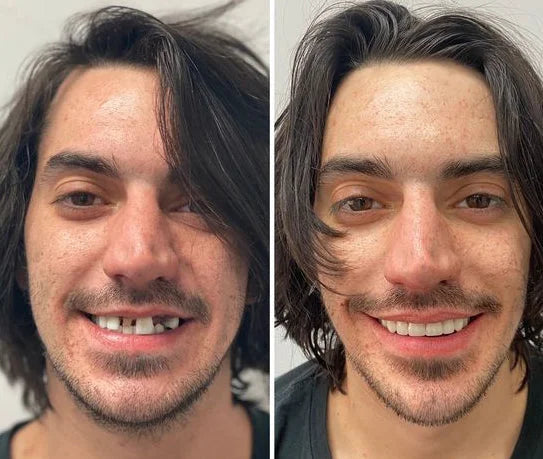 DentGrip™ | Sicherer Halt und ein sorgenfreies Lächeln den ganzen Tag lang